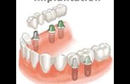 Implantate in Issum